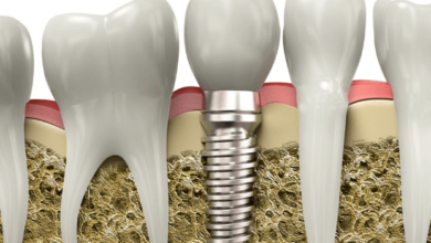 Rediscovering Oral Harmony: The Role of Dental Implants in Jaw Health