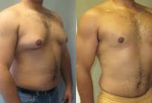 Gynecomastia in Dubai