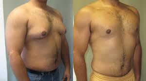 Gynecomastia in Dubai